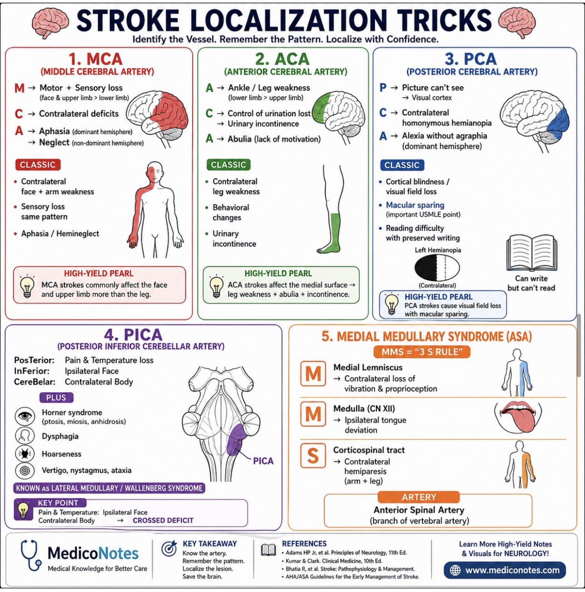 MedicoNotes's tweet photo. 🧠 Stroke Localization Made Simple

⸻

1️⃣ MCA Stroke (Middle Cerebral Artery)

➊ Face & arm weakness > leg weakness
➋ Contralateral sensory loss
➌ Dominant side → Aphasia
➍ Non-dominant side → Neglect

💡 Remember:
MCA = “M” for Mouth & aRM involvement

⸻

2️⃣ ACA Stroke (Anterior Cerebral Artery)

➊ Leg weakness > arm weakness
➋ Personality changes
➌ Abulia (loss of motivation)
➍ Urinary incontinence

💡 Think:
ACA affects the medial brain → lower limb area

⸻

3️⃣ PCA Stroke (Posterior Cerebral Artery)

➊ Contralateral homonymous hemianopia
➋ Visual symptoms
➌ Alexia without agraphia
➍ Macular sparing

💡 Classic clue:
“I can write… but I can’t read”

⸻

4️⃣ Lateral Medullary Syndrome (PICA)

➊ Dysphagia & hoarseness
➋ Vertigo, nystagmus, ataxia
➌ Ipsilateral facial sensory loss
➍ Contralateral body pain/temperature loss
➎ Horner syndrome

💡 Crossed findings = brainstem lesion

⸻

5️⃣ Medial Medullary Syndrome (ASA)

Remember the “3 M’s”:

➊ Medial lemniscus → ↓ vibration/proprioception
➋ Motor pathway → contralateral weakness
➌ Medulla CN XII → tongue deviation

⸻

🎯 Stroke localization becomes easy when you recognize the pattern!

📚 Master neurology with our high-yield Neurology Book 🧠
Available now at:

🌐 https://t.co/2UQyCbb6in

#Neurology #Stroke #MedEd #USMLE #Medical