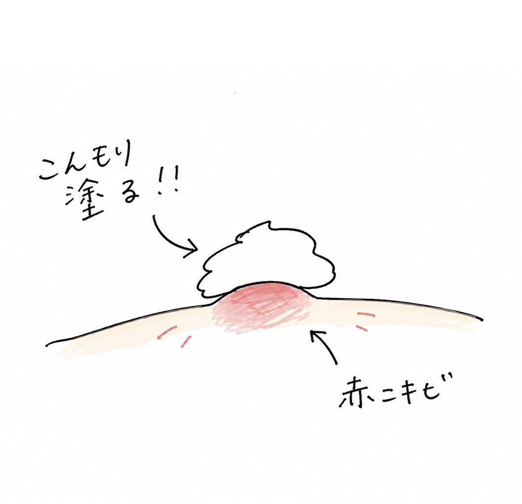 popopopo_i_'s tweet photo. 何回も言うけど、ペアアクネこんもり塗って‼️家に引きこもる日は、塗る→透明→塗る→透明を繰り返して1日でちいさくなる🔁 https://t.co/SId6VwVKGi