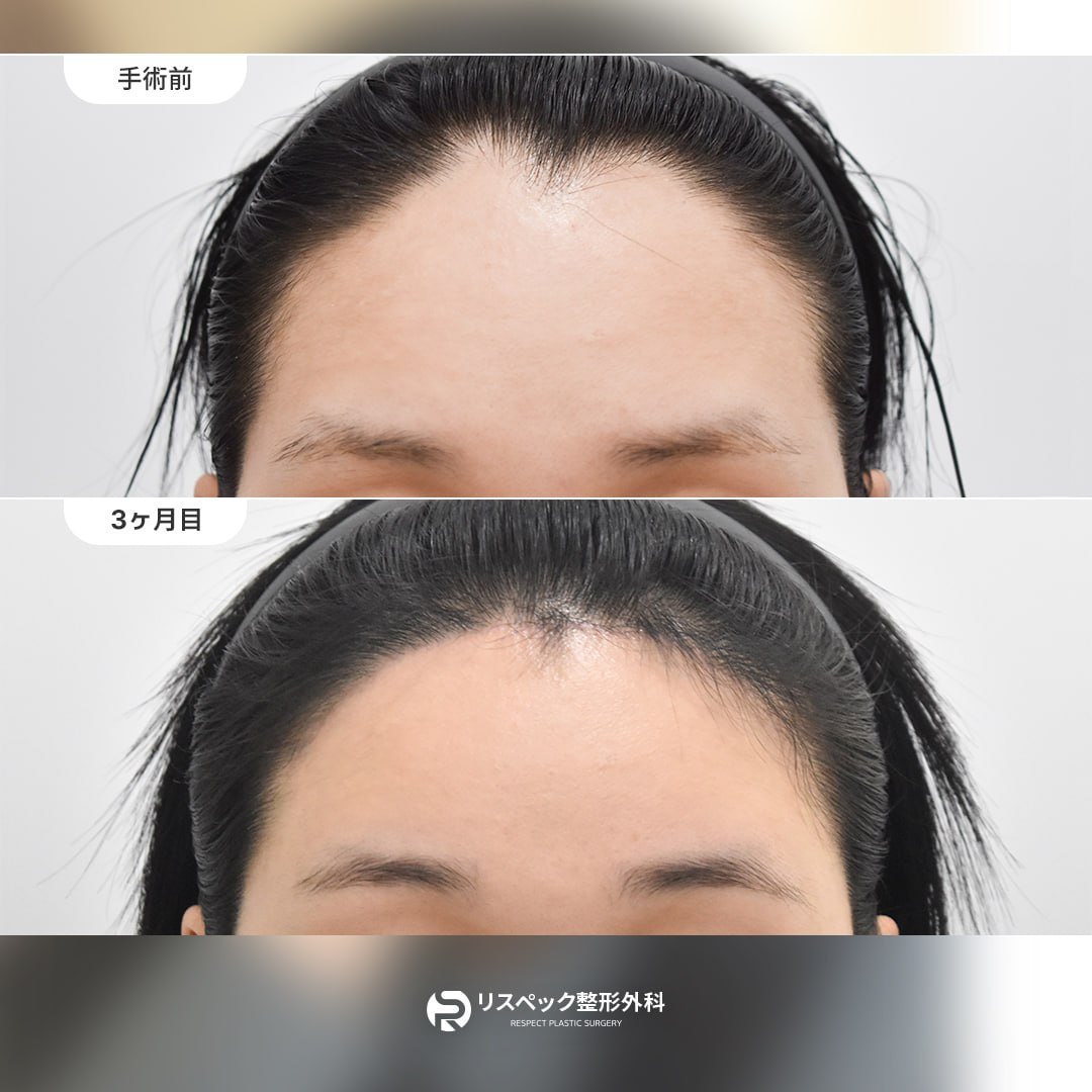 respectps_jp's tweet photo. リスペック整形外科👑

【額縮小＋額リフト：4ヶ月目】

丸く穴が空いたようなヘアラインと、
広いおでこにお悩みだった方

額縮小＋額リフトでおでこの比率を整え、
ヘアラインも自然で丸みのある美しい形に整うことで、
お顔全体の印象がより美しくなります✨

なんとなく垢抜けて見える秘訣、
お問い合わせはLINE: https://t.co/h20EjgEKKS までお願いいたします🍀