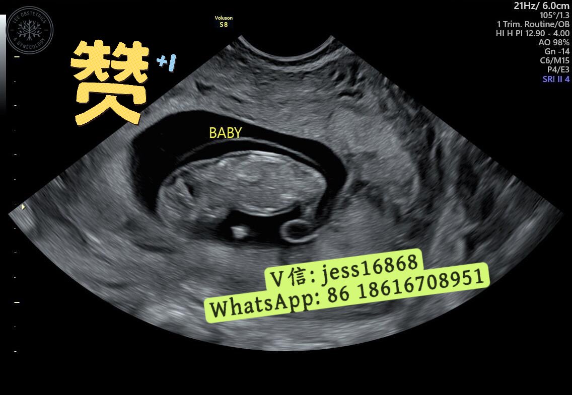 kendria_rod's tweet photo. 中国客人想在美国代孕一次抱三胎，所以团队一次性帮他找好3位美国代母。其中两位代母G、J同时好孕，她俩同时试管移植，都成功怀孕，出了胎心。第三位代母下月准备安排第二次移植，希望这次胚胎能顺利着床，期待客人明年的“三胞胎”组合！

卵子库精子库 供卵 胚胎运输海外代孕  夫妻代怀生龙凤胎/多胎 https://t.co/xvbf4neoT9