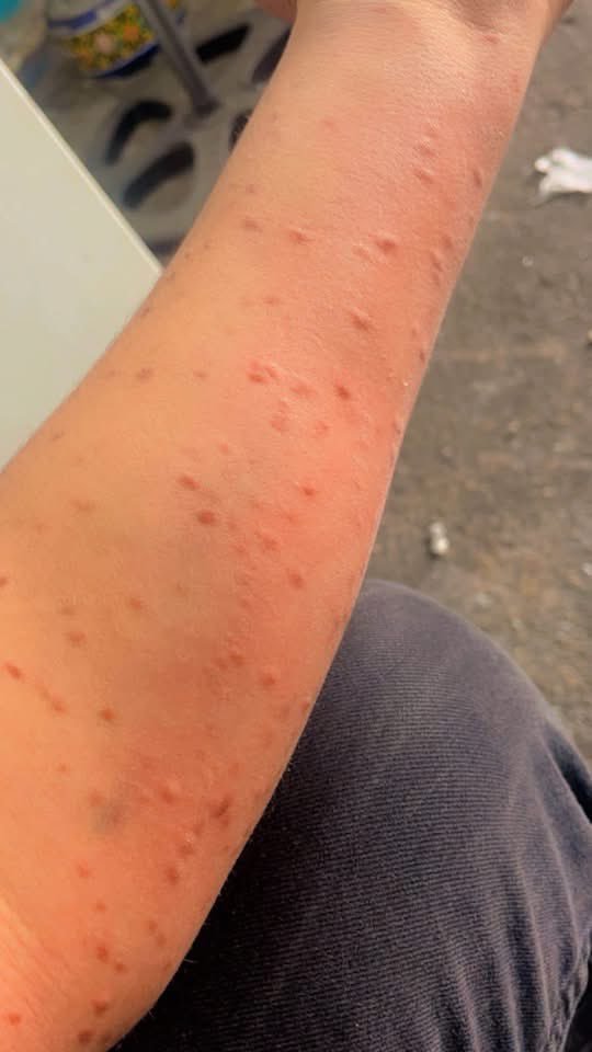 prensseshira's tweet photo. Arkadaşlar lütfen biri açıklayabilir mi ? Abim sanayide çalışıyor fotoğraf attı kolları aniden böyle olmuş. Kaşıntı ve yanma yok. Elini vurdukça yayılıyor? Lütfen bunun ne olduğunu biri biliyor mu ? https://t.co/eKV83AK7sV