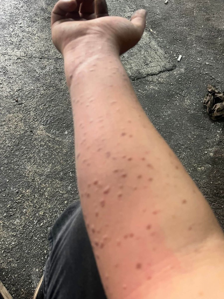 prensseshira's tweet photo. Arkadaşlar lütfen biri açıklayabilir mi ? Abim sanayide çalışıyor fotoğraf attı kolları aniden böyle olmuş. Kaşıntı ve yanma yok. Elini vurdukça yayılıyor? Lütfen bunun ne olduğunu biri biliyor mu ? https://t.co/eKV83AK7sV