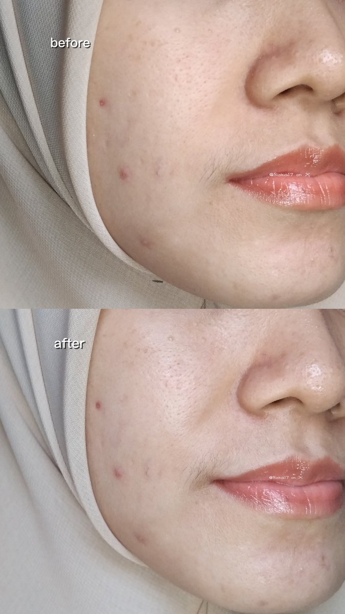 Riska17's tweet photo. sekarang, pake rangkaian skincare jd makin lengkap &amp; terpenuhi, setelah ketemu essence booster ini.

after tenang &amp; fresh yg bener² dibutuhin kulit 💖✨️ https://t.co/G1CLc92KVP