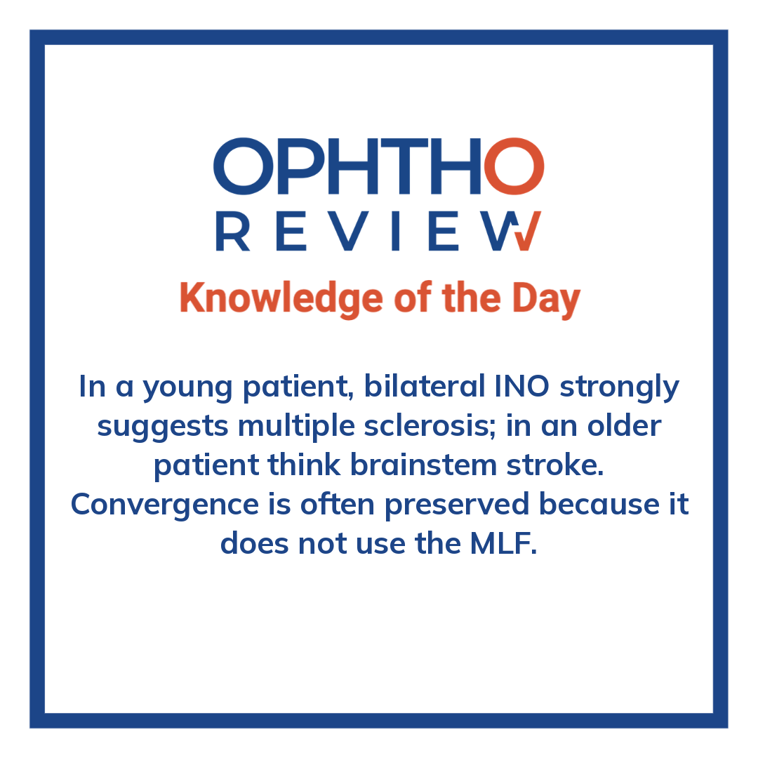 ophthoreview's tweet photo. One eye fail to turn inward

#ophthoreview #ophthalmology #ophtho #ophthalmologyresidency #ophthalmologist #surgicaleducation #medicaleducation #meded #surgery #medicalstudent #medicine #medicalschool #resident #residency https://t.co/rHqingbEkc