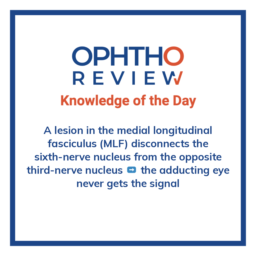 ophthoreview's tweet photo. One eye fail to turn inward

#ophthoreview #ophthalmology #ophtho #ophthalmologyresidency #ophthalmologist #surgicaleducation #medicaleducation #meded #surgery #medicalstudent #medicine #medicalschool #resident #residency https://t.co/rHqingbEkc