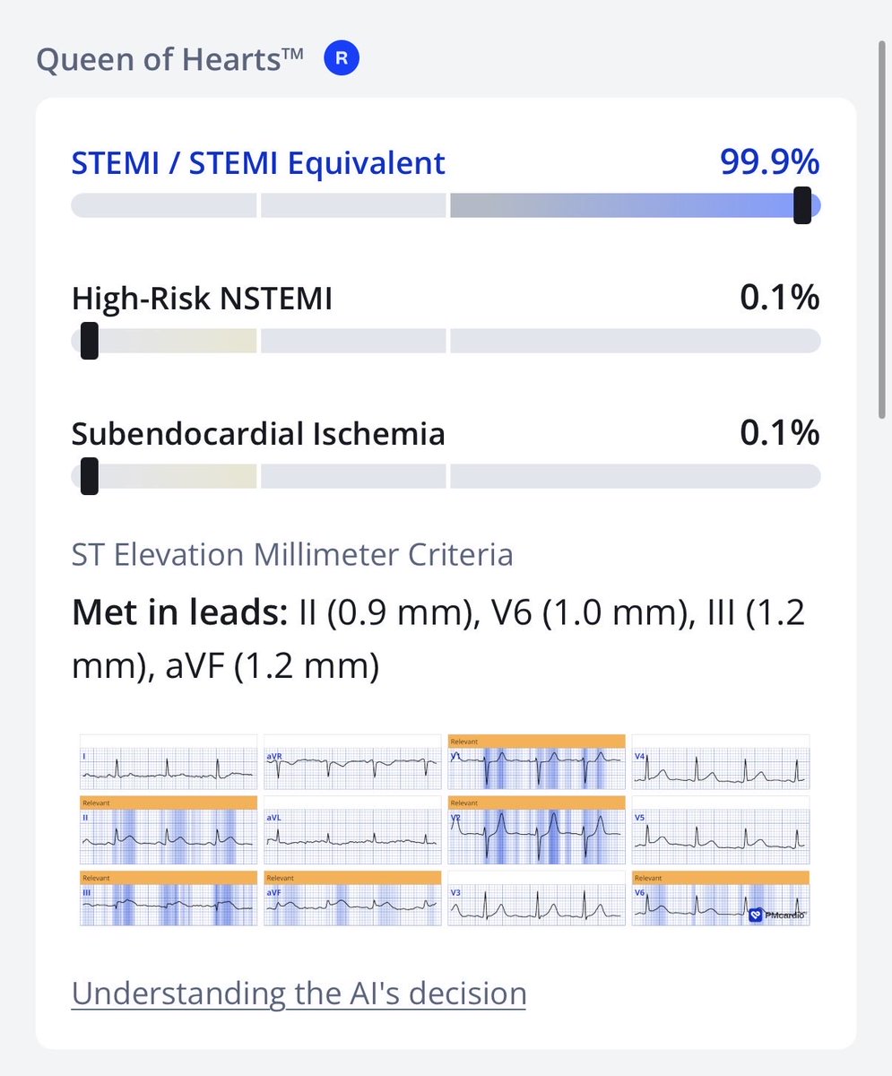 RobertHermanMD's tweet photo. @drmalshehri Should be no doubt here, even meets mm criteria! LCx vs. RCA on the culprit https://t.co/ridvSuByAG