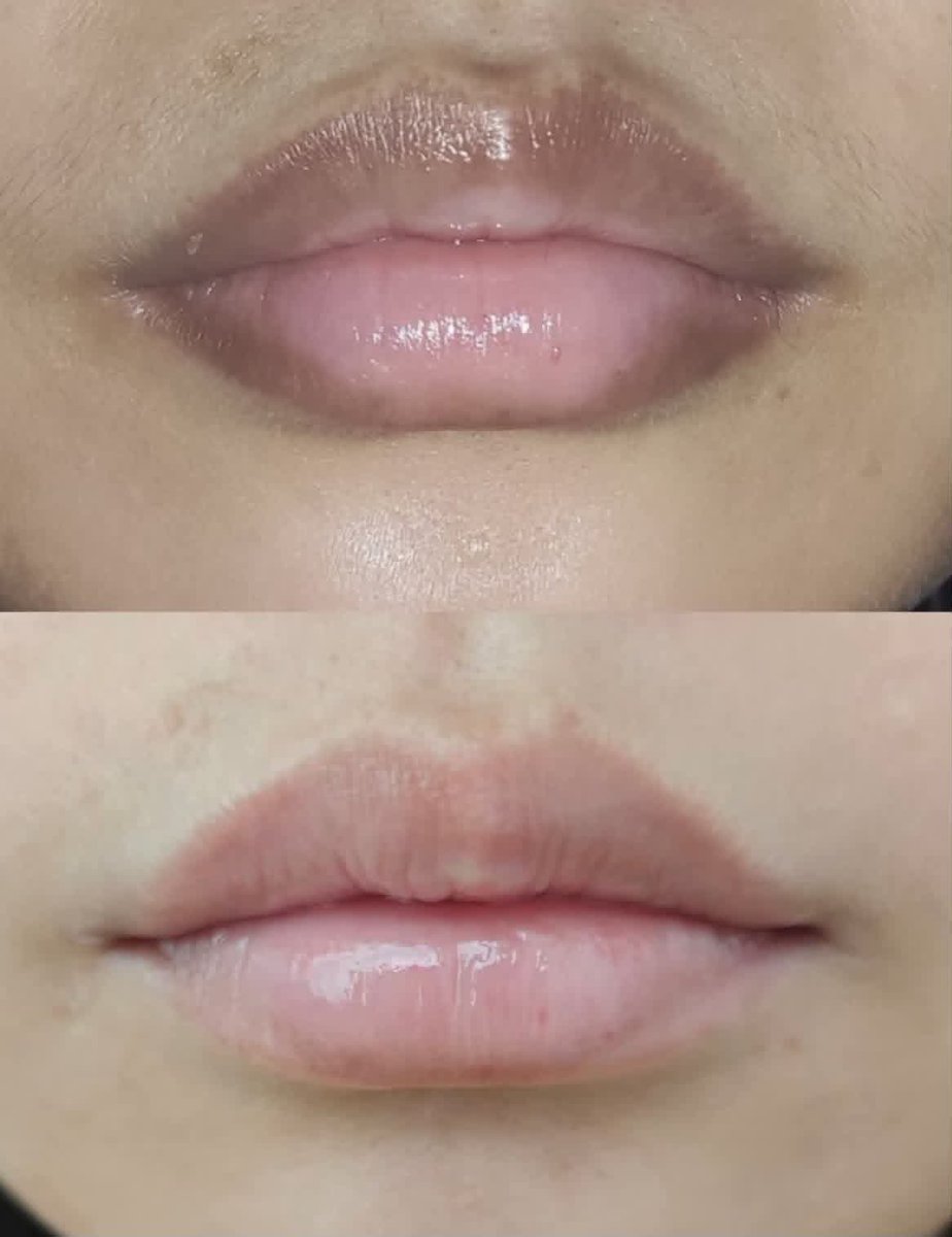 dheyulll's tweet photo. PLISSS BARU TAU😭.. rutin diseal tiap malem hasilnya bkin bibir dari gelap jadi pink gini🙏🏻🙏🏻 https://t.co/X1iM3M3vIk