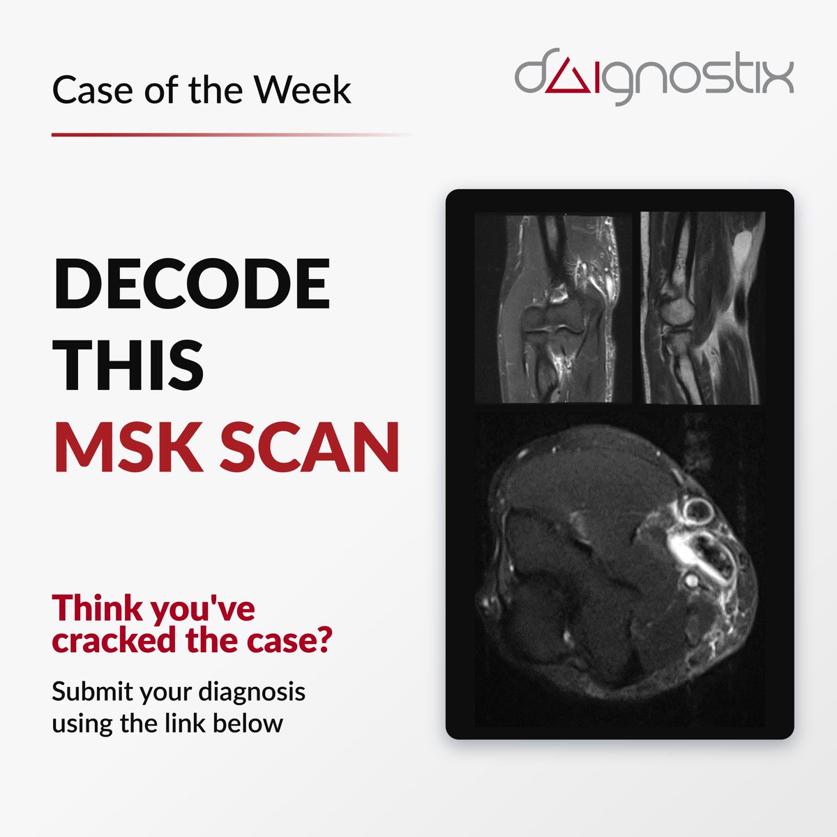 dAIgnositX's tweet photo. Ever felt a sudden pull in your elbow after lifting something heavy? 🤔

This middle-aged patient did. Acute anterior elbow pain.

The MRI is in. Can you spot the tear?

👉 Cast your vote: https://t.co/w42GIW1SGn

#MRI #MSK #Radiology #CaseOfTheWeek https://t.co/NRoMGZ0j7l