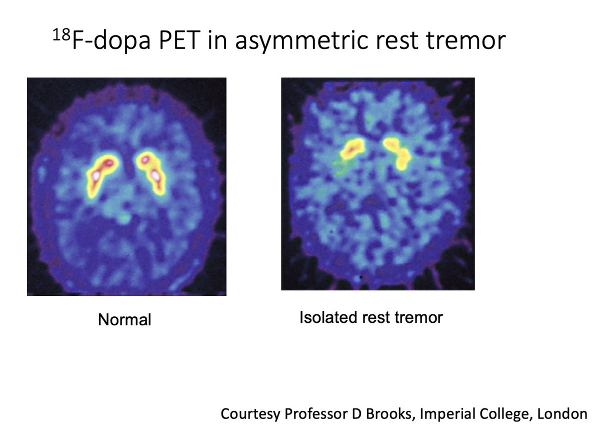 MichaelOkun's tweet photo. One of the most interesting discussions at the Aspen Movement Course centered on persons with a long-standing unilateral rest tremor, sometimes accompanied by a postural tremor, but without clear bradykinesia. Years ago, Professor David Brooks and colleagues used 18F-dopa PET imaging to show that the vast majority of these individuals already had evidence of nigrostriatal dopaminergic degeneration, supporting a diagnosis of Parkinson's disease rather than essential tremor or a functional movement disorder. Subsequent DaT imaging studies and careful long-term clinical follow-up have repeatedly confirmed these early observations. Another important pearl is that younger-onset Parkinson's disease may present with a fine, rapid tremor that can even appear myoclonic at first glance, creating additional diagnostic challenges. The lesson is simple: not every isolated tremor is essential tremor, and careful longitudinal examination, supported when appropriate by biomarkers, remains one of the most powerful tools in arriving at the correct diagnosis.
