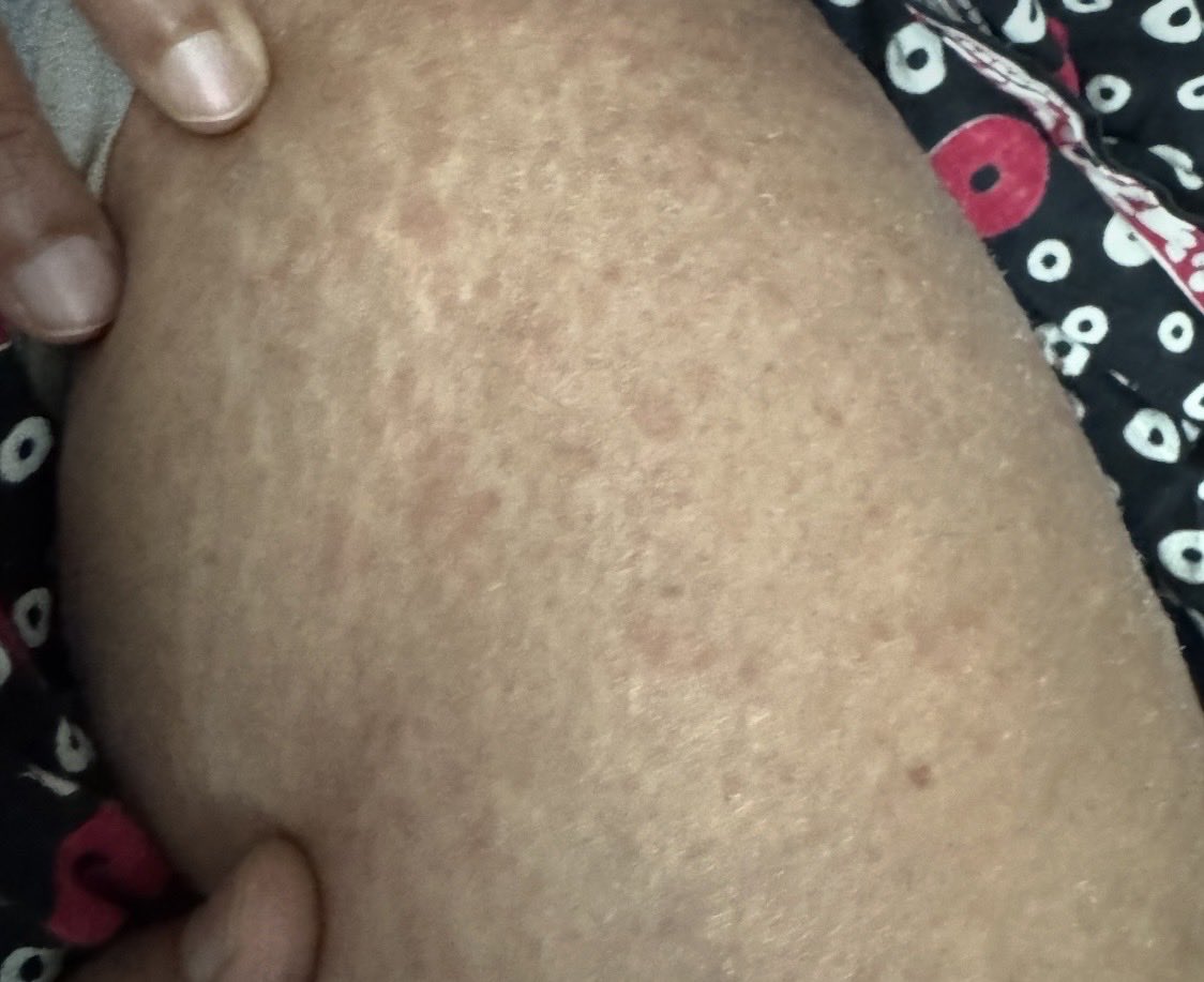 sesha_thiru's tweet photo. 58 year old 2 weeks after trip in Banff . What is the diagnosis. Please help https://t.co/tsDyDG44RL