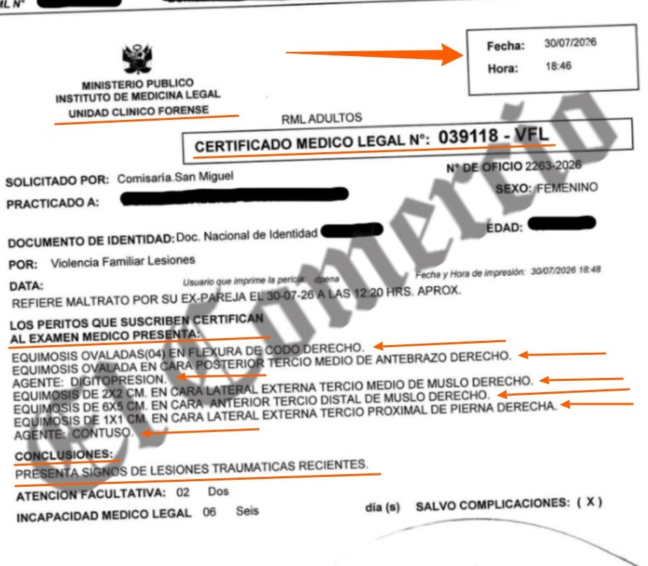 elorwelliano's tweet photo. FUE UNA GOLPIZA
💥ESCÁNDALO | Certificado médico revela hematomas y marcas de agarre forzoso en la expareja del diputado de JPP Julián Pérez Mallqui.

Un certificado médico legal emitido por peritos del Ministerio Público confirmó que la expareja del diputado de Juntos por el Perú Julián Pérez Mallqui, de 44 años, presenta lesiones traumáticas recientes tras la denuncia por presunta agresión física y psicológica. El informe detalla equimosis o moretones en el codo y antebrazo derecho compatibles con presión digital o un fuerte sujetamiento por los dedos, además de hematomas en el muslo y la pierna derecha causados por un agente contuso. En contraste, el examen practicado al parlamentario no registró ninguna lesión traumática reciente.

Los hechos ocurrieron en un inmueble del distrito de San Miguel, en Lima, donde la mujer alertó a la Policía Nacional. Según las actas policiales, los agentes intervinieron tras su llamado; Pérez Mallqui negó haber ejercido violencia física y aceptó el traslado a la comisaría, donde permaneció detenido durante 48 horas antes de ser liberado mientras continúa la investigación. La denunciante aseguró que no se trataba de un episodio aislado y que el legislador le habría dicho: “Te vas a arrepentir de lo que estás haciendo”.

La defensa de la agraviada rechazó la liberación del congresista y solicitó a la Fiscalía que investigue el caso por violencia contra la mujer y violación de domicilio, afirmando que ella fue golpeada, amenazada e insultada incluso frente a los policías. 

Juan Barrantes, el abogado de la víctima, afirmó que el diputado ingresó sin permiso a la vivienda de su expareja por celos y luego la agredió en la comisaría de San Miguel.
"Cuando la víctima salía de los servicios higiénicos para reingresar al área de familia, él la agarró del brazo, le puso cabe para que se cayera y, al no lograrlo, le propinó tres patadas en las piernas", denunció el abogado.

En ese mismo instante, el parlamentario lanzó amenazas para frenar el proceso legal: "Ya vas a ver, esto no se va a quedar así", "No vas a tener trabajo en el sector público".

Pérez Mallqui, quien enfrenta antecedentes judiciales previos incluyendo una condena por lesiones culposas, niega las acusaciones.