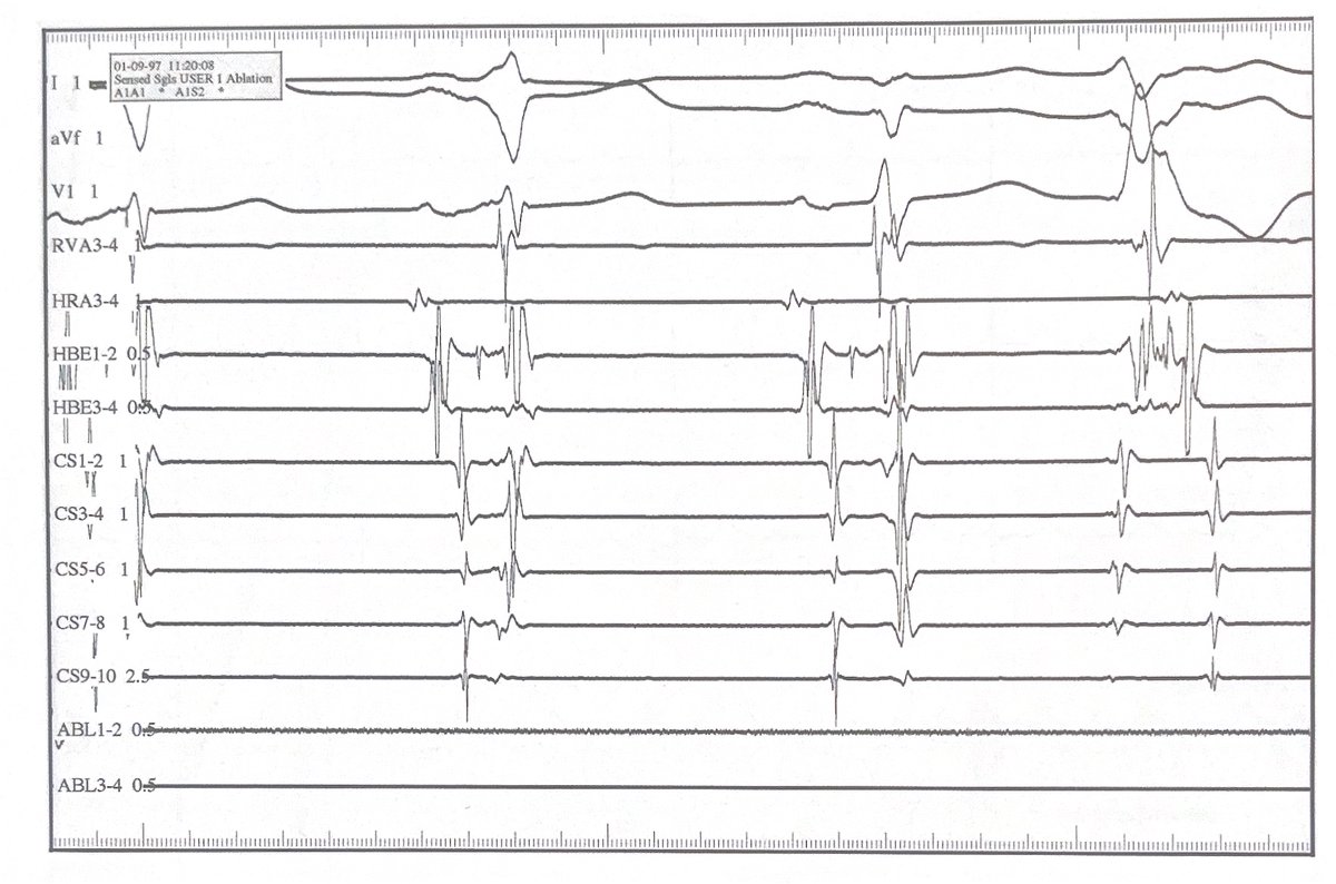 ChartAcademy's tweet photo. What is happening?
#Answers π€
1. Beat 1 - there is a delta wave on the surface ECGs.
2. Beat 2 - the delta is gone, A-V interval on the prox CS (9-10) lengthens. The AP is destroyed by RF energy.
#EPeeps #EGMREview #CultureofLearning #RCES #CEPS #deviceclinic https://t.co/oKDgtK8FhE