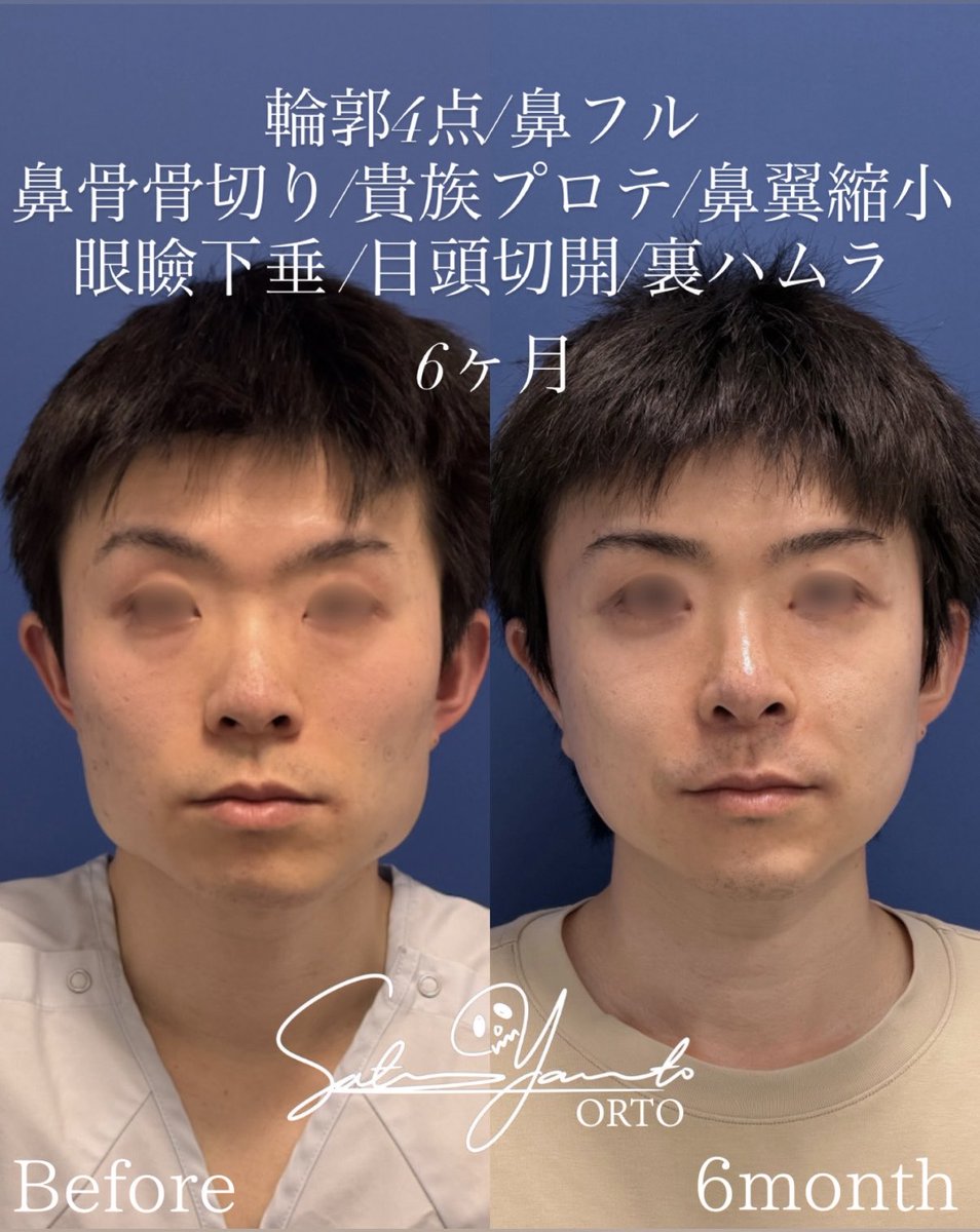 Satoru_ORTO's tweet photo. 日本人のお顔の悩みの多くが、「平坦顔」に帰結する。頬骨は張り出し、鼻周りは陥凹する。鼻と顎が前方に伸びていないので、口元が出て見える。

ならどうするか。

頬の張り出しを抑え顔を流線型に整えるのは頬骨セットバック。陥凹した中顔面を押し出すのは鼻フル＋猫貴族。足りない顎を前に押し出すオトガイ形成と、エラの張り出しを適正化するVライン形成。

全ての要素を調整することで、顔は平坦顔を脱却する。

輪郭4点
鼻フル　肋軟骨
猫貴族　肋軟骨
鼻翼縮小
鼻骨骨切り
眼瞼下垂
裏ハムラ
目頭切開
術後6ヶ月