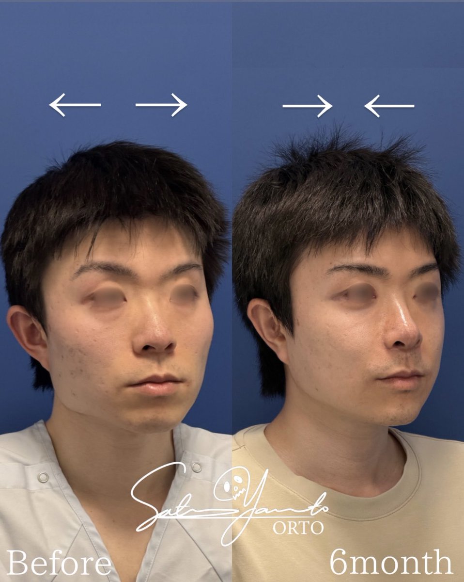 Satoru_ORTO's tweet photo. 日本人のお顔の悩みの多くが、「平坦顔」に帰結する。頬骨は張り出し、鼻周りは陥凹する。鼻と顎が前方に伸びていないので、口元が出て見える。

ならどうするか。

頬の張り出しを抑え顔を流線型に整えるのは頬骨セットバック。陥凹した中顔面を押し出すのは鼻フル＋猫貴族。足りない顎を前に押し出すオトガイ形成と、エラの張り出しを適正化するVライン形成。

全ての要素を調整することで、顔は平坦顔を脱却する。

輪郭4点
鼻フル　肋軟骨
猫貴族　肋軟骨
鼻翼縮小
鼻骨骨切り
眼瞼下垂
裏ハムラ
目頭切開
術後6ヶ月