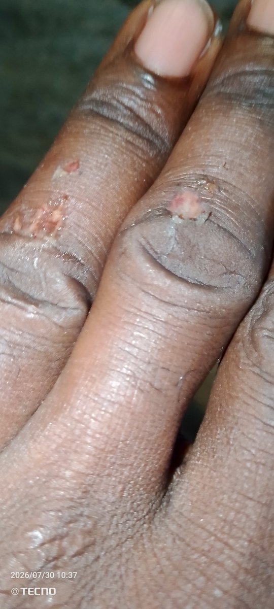 marcusobodo's tweet photo. Diffienetly it hurt but will just be fine https://t.co/G0QFCzLVh0