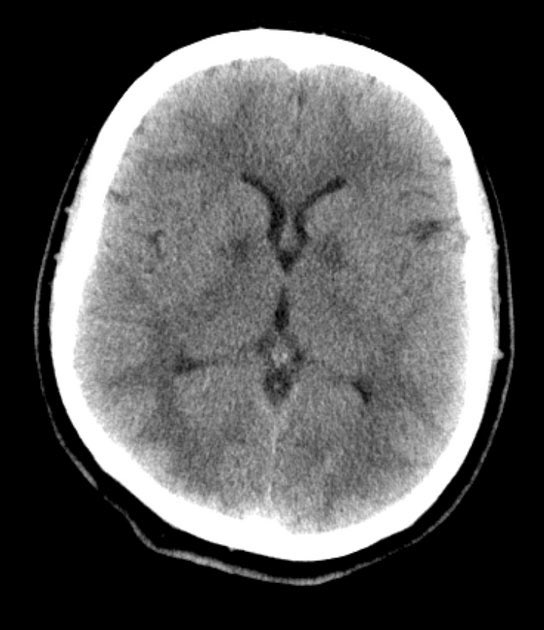 DrAyubaD's tweet photo. Middle-aged patient found unconscious in a closed room with a faulty heater. Now with headache, confusion and cherry-red skin.

What is the diagnosis ? https://t.co/dRmMfMPj5N