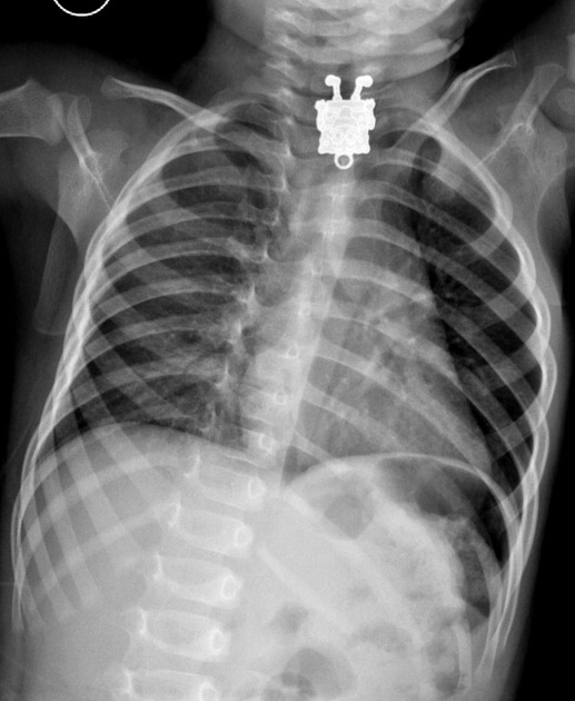 AdamPrabata's tweet photo. Anak 16 bulan dibawa ke dokter karena menelan sesuatu, namun tidak diketahui apa bendanya.
Saat diperiksa dengan rontgen, ternyata ditemukan ada mainan spongebob di kerongkongannya.

Mainan tersebut berhasil dikeluarkan dengan selamat, untungnya.

Sumber: Radiopaedia https://t.co/dXhBYiqlUb