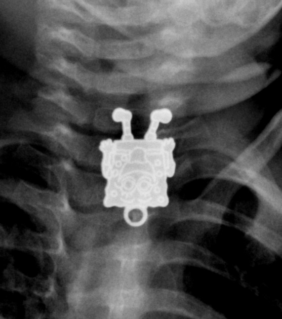 AdamPrabata's tweet photo. Anak 16 bulan dibawa ke dokter karena menelan sesuatu, namun tidak diketahui apa bendanya.
Saat diperiksa dengan rontgen, ternyata ditemukan ada mainan spongebob di kerongkongannya.

Mainan tersebut berhasil dikeluarkan dengan selamat, untungnya.

Sumber: Radiopaedia https://t.co/dXhBYiqlUb
