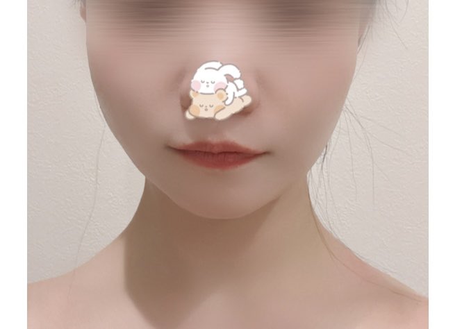 f_rinaly's tweet photo. @planetps_ko 
切開リフト1ヶ月経過
傷跡も綺麗でわかりづらく、無駄な顔の皮？がなくなって自信がつきました！！輪郭がとっても綺麗で、実年齢よりさらに幼く見られるようになりました！ https://t.co/sDEGTLS2Tq
