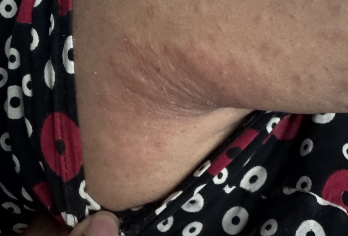 sesha_thiru's tweet photo. 50 plus year old after a hiking trip 3 weeks ago and Zithromax week after return. Any suggestions . Much appreciated. https://t.co/SmTY3DYvXH