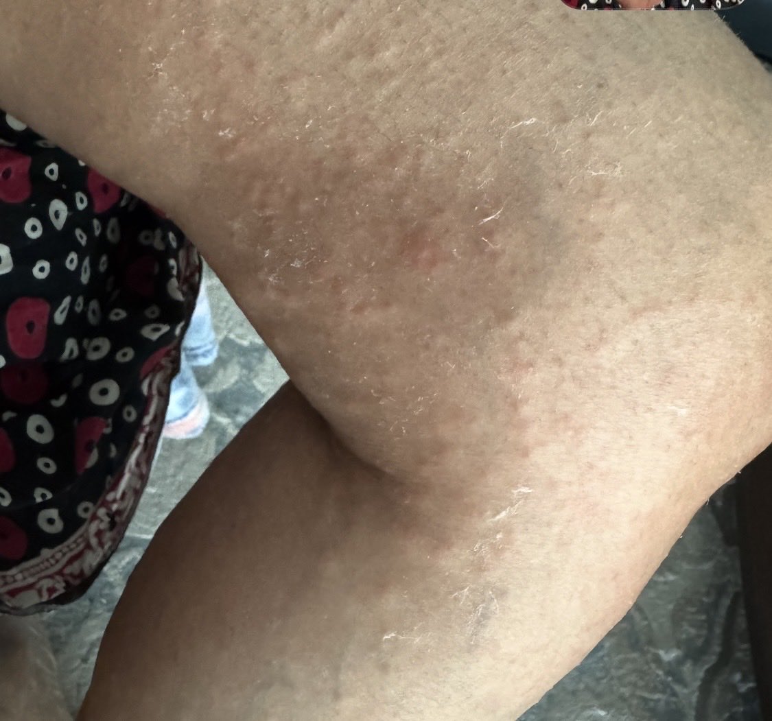 sesha_thiru's tweet photo. 50 plus year old after a hiking trip 3 weeks ago and Zithromax week after return. Any suggestions . Much appreciated. https://t.co/SmTY3DYvXH