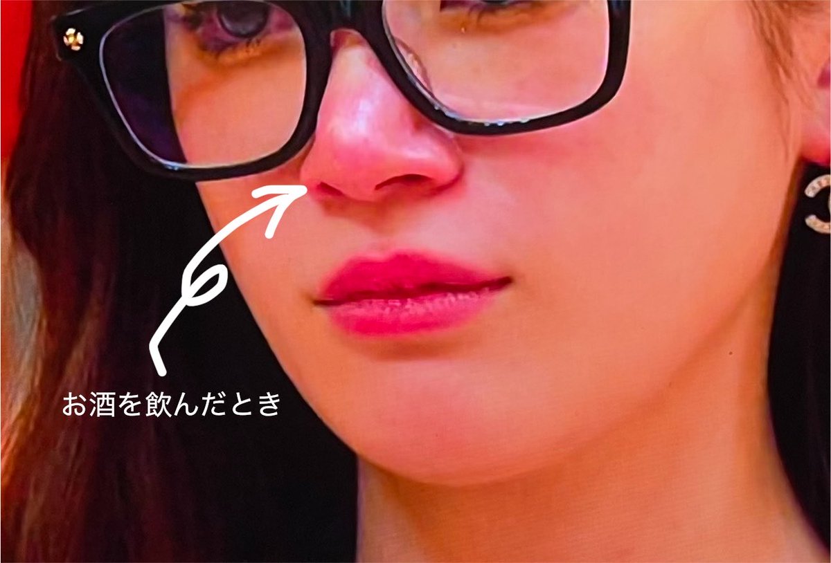 rin3ten's tweet photo. ラブ上等あっすんのお鼻、感染��こしてないかめっちゃ心配になっちゃう。。。

鼻尖形成で韓国版オステオポールみたいな異物入れられてるから鼻先に赤みを感じる。

特に鼻先の圧迫が強いとお酒飲んだ時に炎症起こすんだよね。これはヒアルロン酸にも言える。 https://t.co/VAchrqptdE