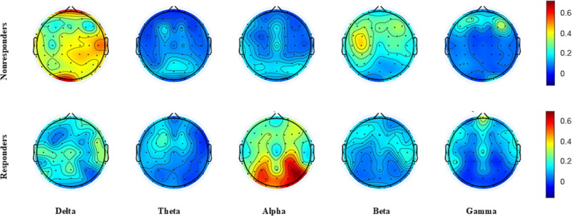 ClinicalNeuroph's tweet photo. [Depression] Ma et al.: "A resting electroencephalography model predicts antidepressant response in depression using three biomarkers." https://t.co/GrsZehLHsM https://t.co/fcBpYAhQGY