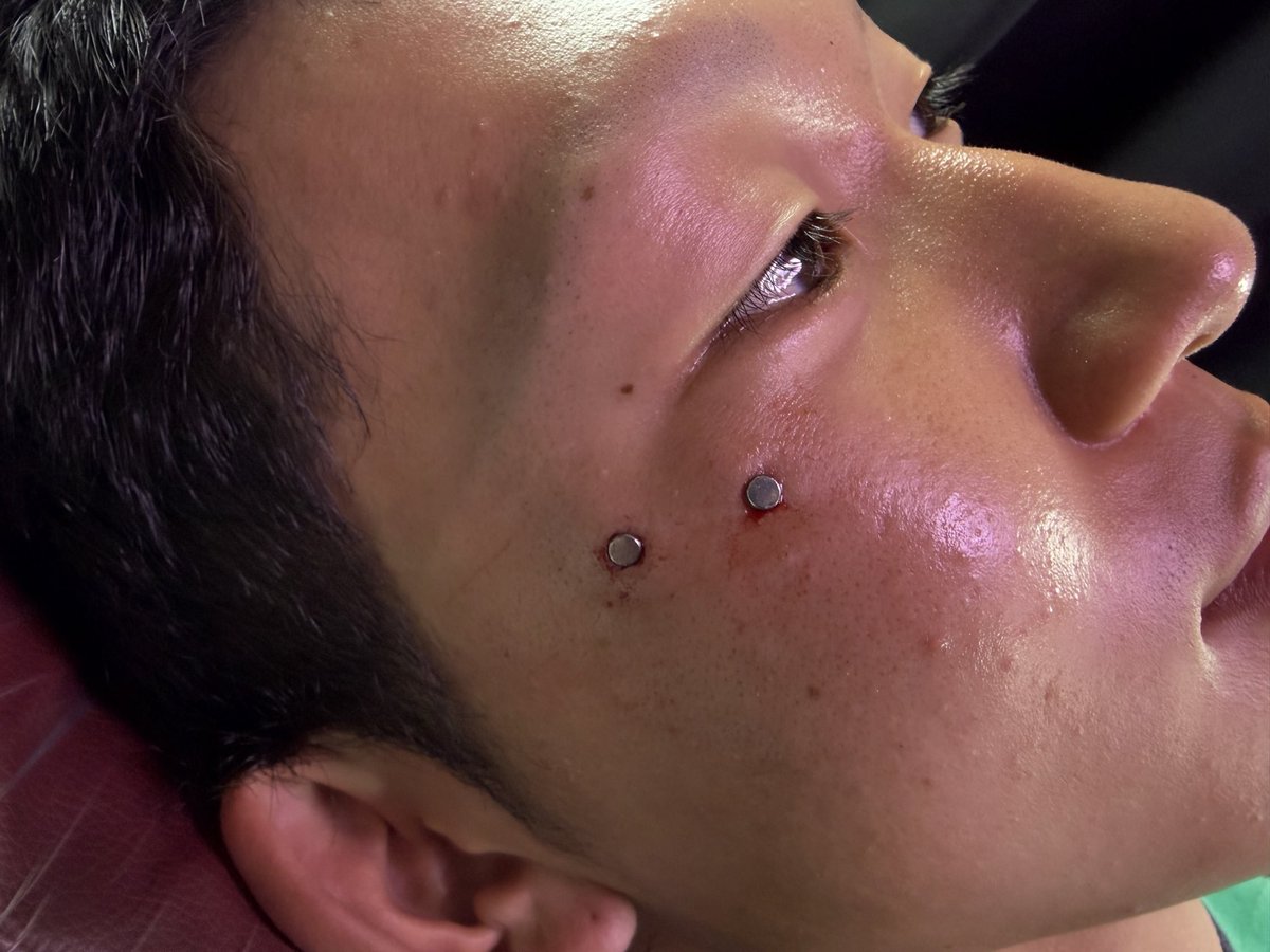 96Olver_pf's tweet photo. .
アンチアイブロウ
マイクロダー���ル

#ピアス
#piercing
#ピアススタジオ
#アンチアイブロウ
#マイクロダーマル https://t.co/AKiMcTiifh