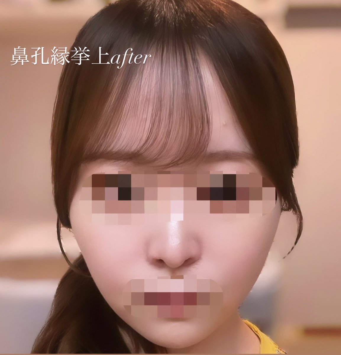 s2_nnny_'s tweet photo. 個人的満足度が高かった整形🎀
📍#鼻孔縁挙上

周りの人には全く気づかれなかったけど、個人的にはかなり満足してる🥺♡

ダウンタイムもそこまで辛くなかったし、元々気になってた左右差と、肉厚感が少し軽減された😌

年末に鼻尖形成検討中🫧
#整形垢 #美容垢 #整形垢さんと繋がりたい #鼻整形 https://t.co/iMXjvd7m2I