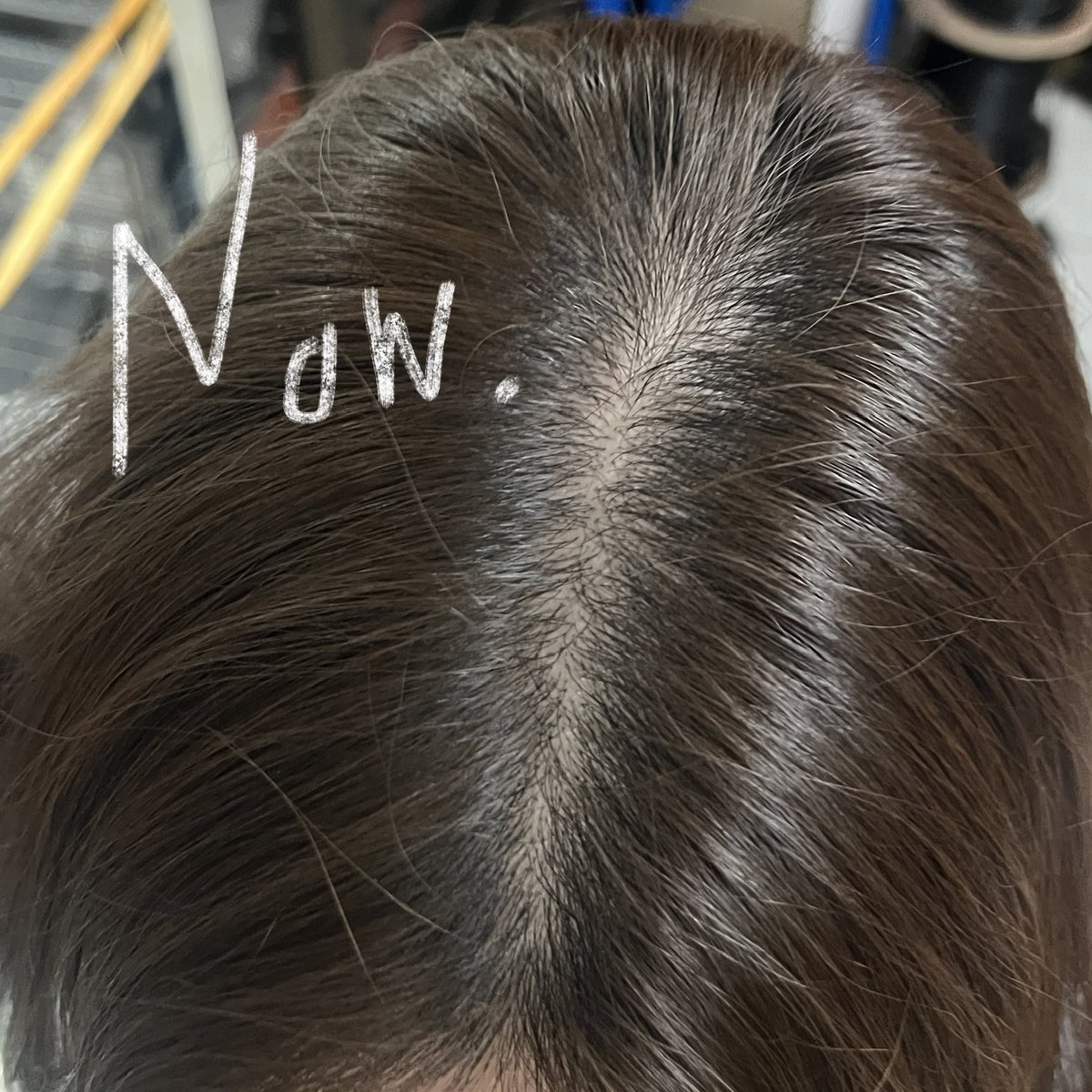 folder022's tweet photo. มีใครลองใช้ nectapharma ยัง กู้ชีวิตลีโอไ���ซิ่งหัวล้านให้เหลือแค่หลักแสนได้อะ (ไม่ตลก) ชั้นใช้ไปแค่ 2 หรือ 3 ขวด (ลืม) เลิกใช้เพราะจน แต่ปัจจุบันผมก็ไม่ร่วงเพิ่ม ยังคงไว้ที่หลักแสน (พอได้แล้ว) ไว้มีเงินจะซื้อมาใช้ใหม่ 

ปักตะกร้าๆๆ ไปหาวันกดโค้ดเอาเอง https://t.co/b5yYv2iZNI https://t.co/LdYb6MU0XP