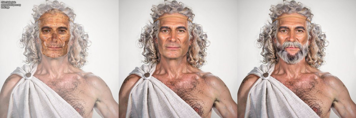Sulkalmakh's tweet photo. Facial reconstruction of a 2,150-year-old man from Chios, Greece  

Ancient Greek medical texts, including those attributed to Hippocrates, describe various forms of cranial surgery. However, the practice of cranial surgery in Greece predates Hippocrates by many centuries. The oldest skeletal evidence of trepanation was found in a Minoan ossuary in Crete (2200–1720 BC). Trepanned skulls from different periods have also been discovered in Delphi (1700–1750 BC), the Peloponnese (1400–1060 BC), Crete (8th century BC), Abdera (7th century BC), and elsewhere, indicating a wide geographic and chronological distribution (Georgios Tsermoulas, Asterios Aidonis, Graham Flint, 2014).

The burial at Chios, a cist tomb dating to the second half of the 2nd century BC, contained the remains of a man estimated to have been around 50 years old. His skull had a circular opening in the left parietal region, measuring approximately 1.62 cm in diameter. Examination of the margins of the opening indicated that it was surgically created and had undergone substantial healing, suggesting that the man survived the procedure.  
According to anthropologist Asterios Aidonis, the limited signs of infection and the degree of healing indicate that the individual may have survived for approximately five to six years after the operation, eventually dying at around 50 years of age.