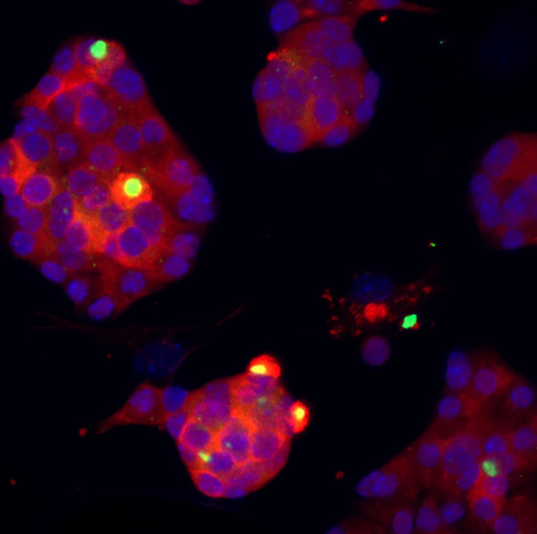 jclinicalinvest's tweet photo. Weekend Read: 🧵 1/3 | JNK inhibition rescues beta cells from ER stress-induced apoptosis https://t.co/q63VnkJ6TR
The findings of Laura C. Alonso & team @WeillCornell highlight the potential for targeting JNK/p53 signaling in the unfolded protein response to preserve insulin secretion in #Diabetes. 
In the featured images, TUNEL and insulin colocalization reveals that JNK inhibition (1/2) rescued beta cell death in cultured islets compared with DMSO treatment (2/2).
@the_asci
