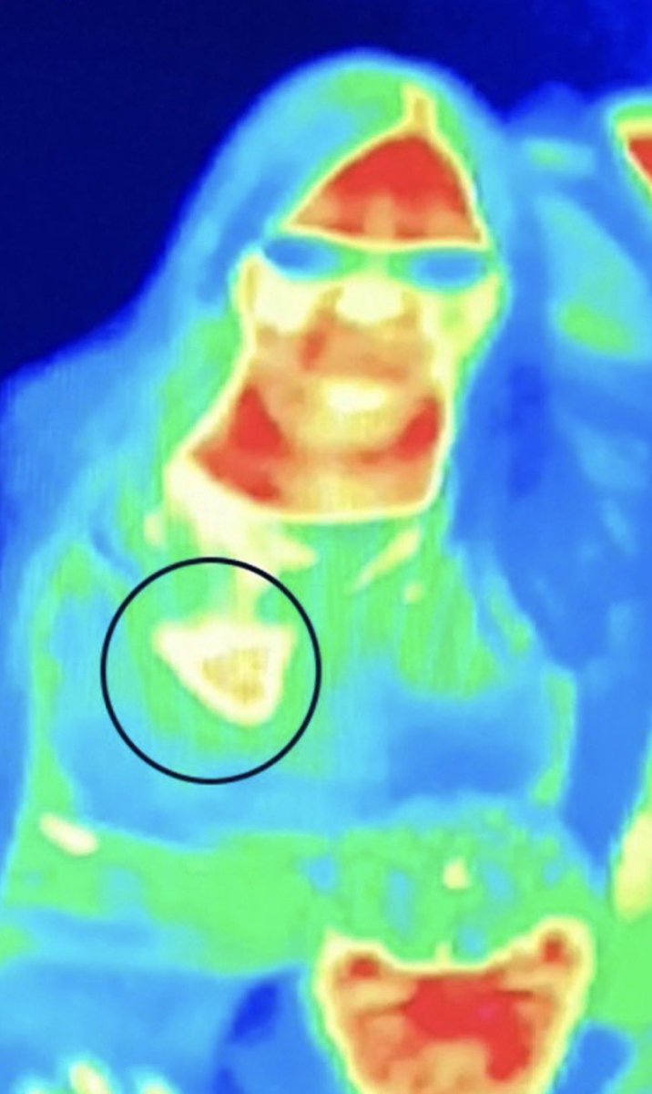 BrianRoemmele's tweet photo. This Should Be The First Line Of Defense For All Women

This is a women named Bal Gill. And her story is almost impossible to believe. She was visited the Camera Obscura and World of Illusions in Edinburgh in May, it was an exhibition. On display was a thermal imaging camera. Upon examining the image Bal noticed a heat patch showing up above her left breast.

Nobody else around her appeared to have a similar spot. She photographed it and when she got home she searched online for what it might mean.

She discovered documented cases where such a patch had indicated the presence of breast cancer.
She sought medical advice and was diagnosed with early-stage cancer in that breast.

Her condition was caught in time and treated successfully and she is healthy today. She believes the thermal imaging camera may well have saved her life.

But if it is genuinely that straightforward to spot then it does make one wonder why mammograms are so consistently promoted as the primary method of detection.

Thermal imaging cameras are inexpensive, here is one for $199 https://t.co/3pBq8Q0cLz.

If such a camera can provide a meaningful early detection it would be simpler, more affordable and far less invasive to have this early detection method in the hands of as many women as possible.

It does not replace medical imaging. Although it is debated if monographs do more harm than good statically. 

If you are a women or for the women you love make thermal images become a regular thing, you came also make the routine fun, think of the ways…

Save a life.