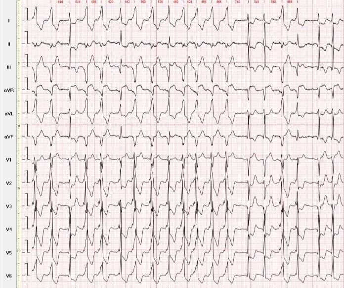 rowroi558's tweet photo. VT with capture and fusion or Pre-Excited AFib? Sorry for pic quality, max HR here is only 140 @The_Nanashi_O @EcgOxford @Ecgloverr @ecgandrhythmRoe @ecgrhythms https://t.co/q22E7Kls01