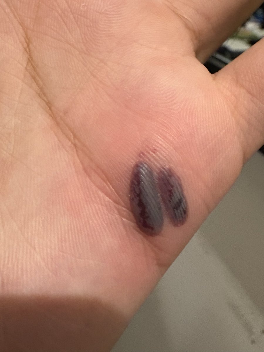 itonihon's tweet photo. 見るのご注意です！
ブロック🧱を持って置く時手だ挟まれてて、こうになった、チャッピーを聞いて「冷たい湿布を使ってほうがいい」と言った
ちょっと痛いけど、なんかこの部分がだいぶ固まった！
明日、ジムやりたいけど、やれるかな？ https://t.co/cXpIxfqs4n