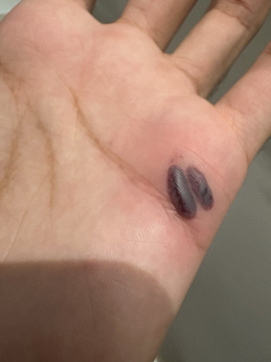 itonihon's tweet photo. 見るのご注意です！
ブロック🧱を持って置く時手だ挟まれてて、こうになった、チャッピーを聞いて「冷たい湿布を使ってほうがいい」と言った
ちょっと痛いけど、なんかこの部分がだいぶ固まった！
明日、ジムやりたいけど、やれるかな？ https://t.co/cXpIxfqs4n