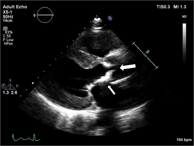 RitikaTuliMD's tweet photo. 🫀 CardioNugget™ | Mediastinal Radiation

Thickening + calcification of the aorto-mitral curtain (AMC) is a characteristic echo finding of prior mediastinal radiation.

The AMC = fibrous continuity between the aortic and mitral valves → radiation causes progressive fibrosis → thickening → calcification.

💡 Why it matters: Extensive AMC calcification reflects more advanced radiation-associated cardiac injury and has been associated with increased mortality after cardiac surgery.

#CardioNugget #CardioTwitter #Cardiology #Echocardiography #EchoBoards #CardioOncology #RadiationHeartDisease #MedEd