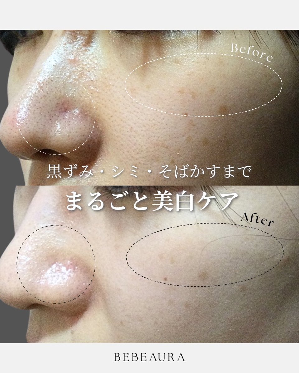 bebeaura_salon's tweet photo. 肌悩み…あれもこれも気になる…
そんな時、トータルケア出来る肌質改善メニュー💎

2週間〜月に1回のサロンケア（6回）継続してここまで肌が変化✨

肌の透明感や印象を変えるには【HARIトリートメント】を🥼🤍

ご予約はこちらから↓

https://t.co/UdwxmUbrsF https://t.co/uJ0Ji7iwCg