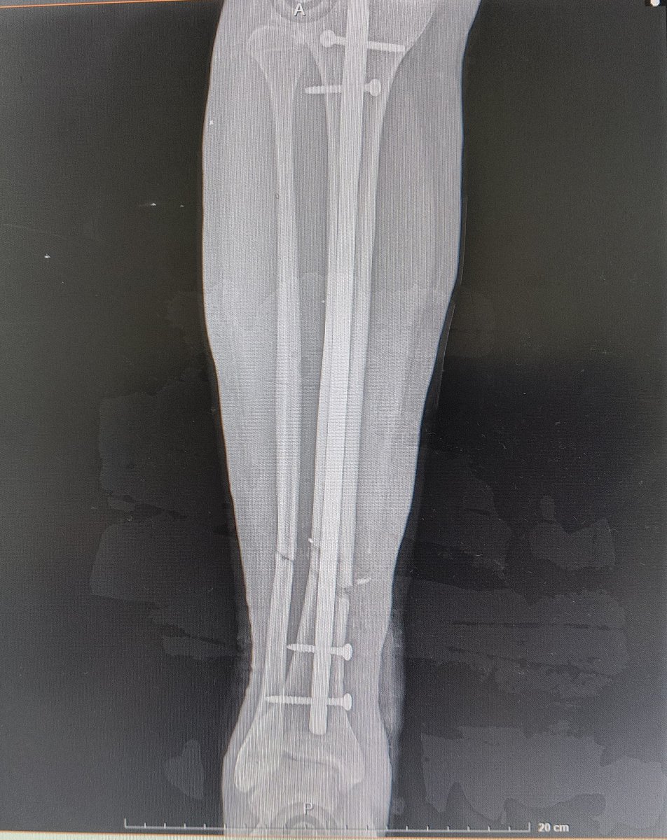 Torlsteinacst's tweet photo. Fractura de tibia y perone, manejada con reducción cerrada y fijación interna con clavos centromedular de tibia

#med #medicine #tyo #orthopedicsurgery #radiology #traumatology #medstudent #resident #fracture https://t.co/Xb9JhWzDKj