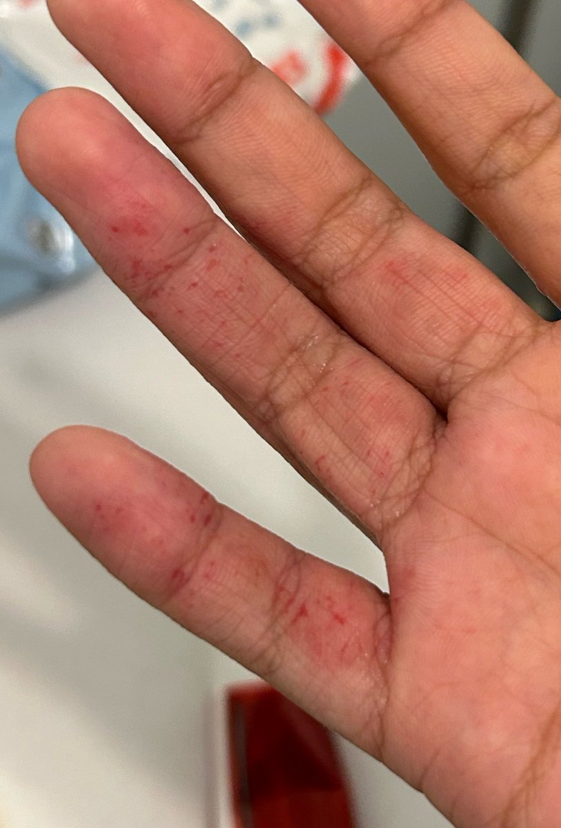 Cam_Mac64's tweet photo. If you want to use nair with eczema…please dont. https://t.co/c7hKPETteD