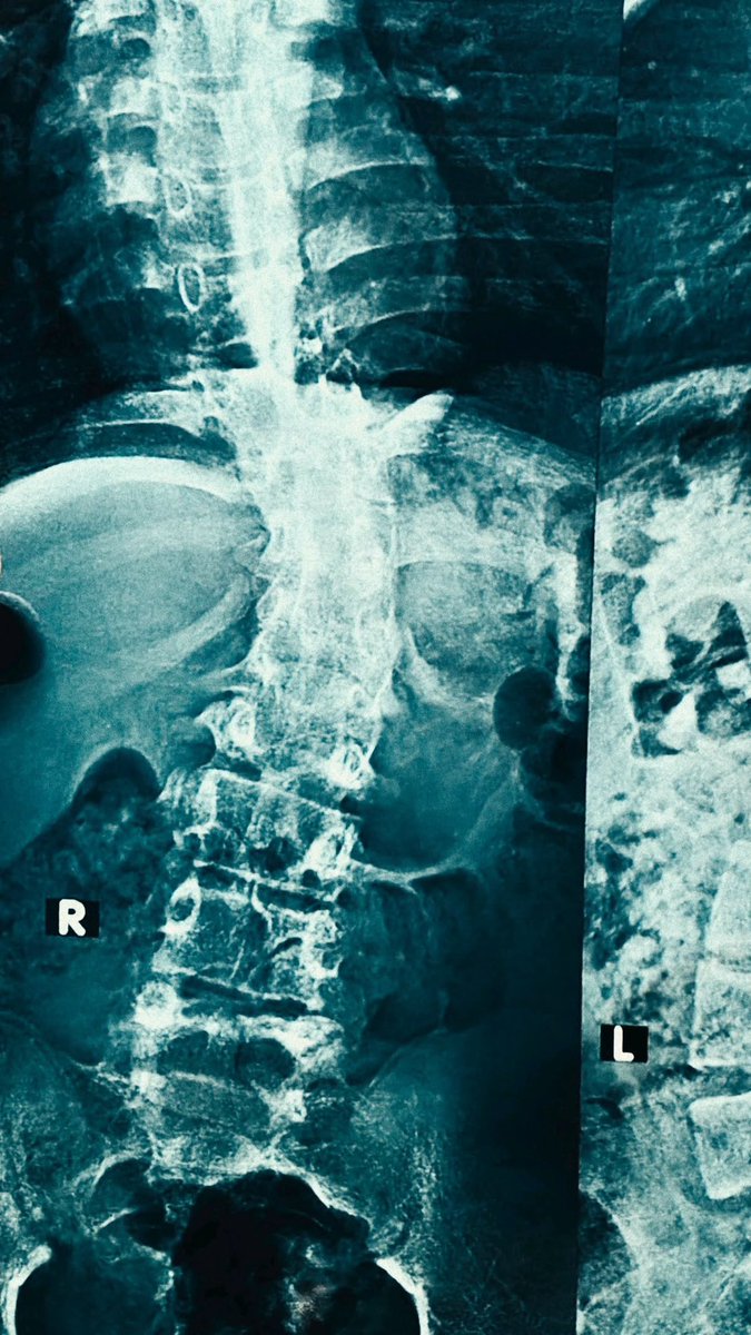 HealthyAlfred's tweet photo. BPC-157 grew back bone that was physically sawed out of a leg.

not cracked. not fractured. SAWED OUT. 0.8cm. removed. gone.

controls never healed. gap stayed open. permanent.

BPC-157 grew it back. matched surgical bone grafts. published.

(PMID: 10071911)

let that hit you. a stomach peptide matched a $20,000 surgery. for nanograms.

and bone was EASY for it:

→ nerve cut in half — REGREW (19903499)
→ heart flatlined — RESTARTED (23327997)
→ spine crushed — 360 DAYS (31266712)
→ knee — REBUILT from water (20225319)
→ 7 organs dying — ALL REVERSED (PMC8533388)

this wasn’t a rat. RABBIT. larger animal. denser bone. closer to you.

zero lethal dose. zero side effects. 30 years. $100.

15 amino acids. your stomach already makes it.

🧵 how I take it + source in the comments ↓