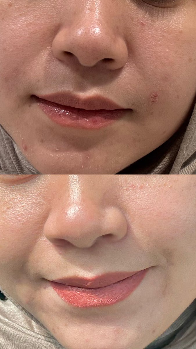 AsnadiaD's tweet photo. I takkan berhenti menekan akak Millenials yg menolak tua, ada mslh pores terbukak, skin meragam, kusam and sensitif tu.

PLEASE try combo Rejuran + Dr. Althea and konsisten je, sumpah menjadik weh😱

Makeup simple pun dah helok.. Lipstik takdan pakai ooii kejar lighting🤣￼ https://t.co/SANnxw0arg