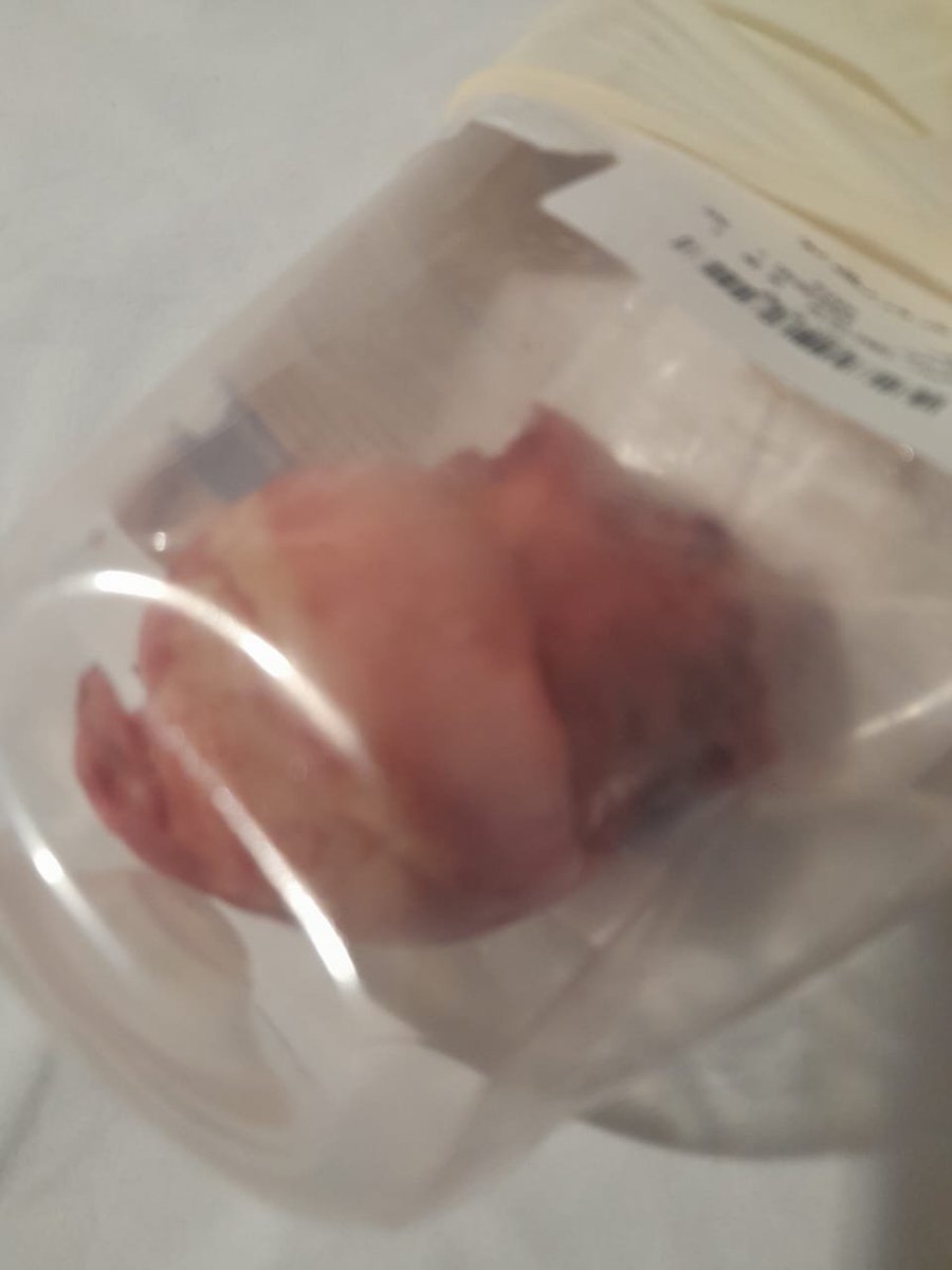 oliveegirl's tweet photo. This is part of the femur bone after @khalidyemeni59 orthopedic surgery here in Egypt.
Khalid is a Yemeni father who is struggling so much, &amp; he might lose his house in Yemen if he does not pay back the loan he took for his surgery.

Donate: https://t.co/R3QC97QZfK

SHARE! https://t.co/alfAefCAXF