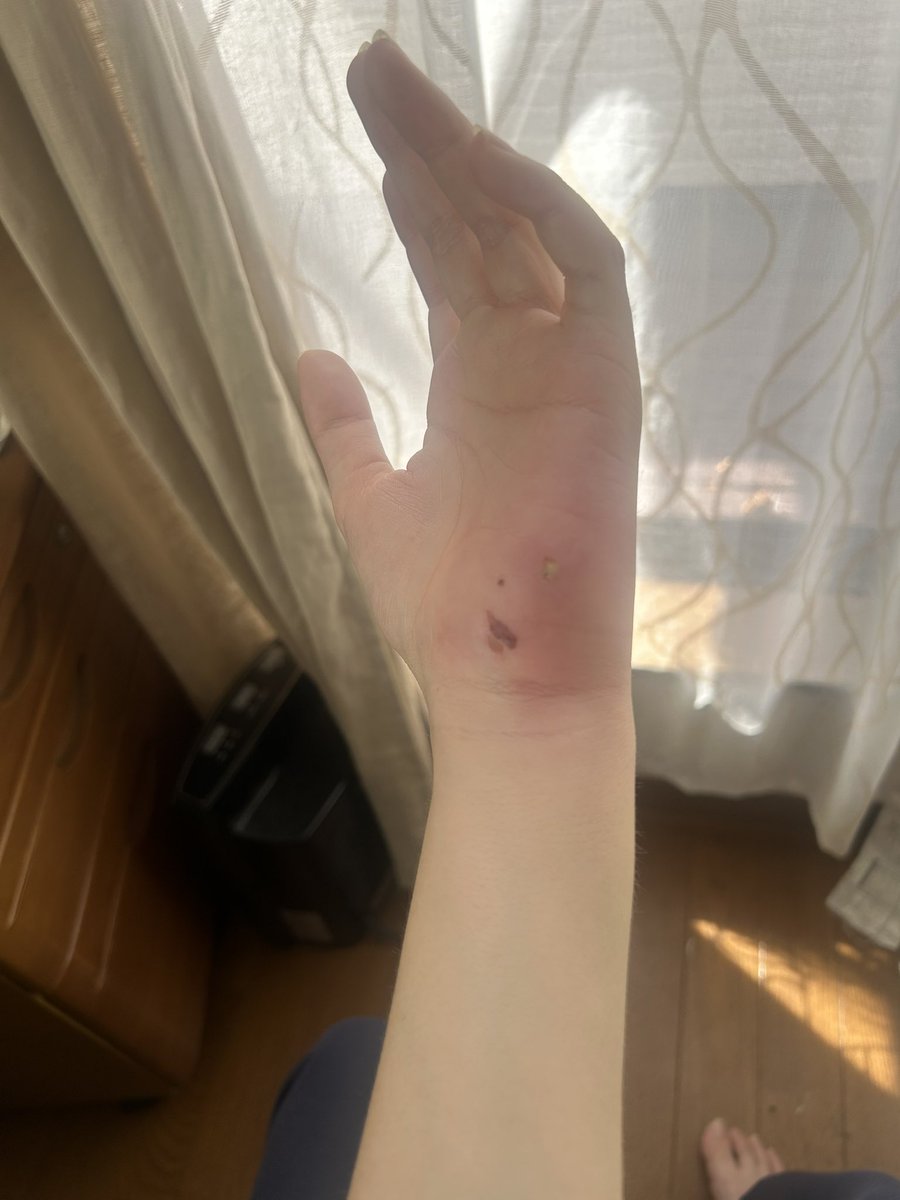 kanajump0922's tweet photo. 自宅のイッヌに噛まれた所が5日経っても治らないし腫れ引かないから病院きたけど
なんや危うく破傷風？手術で膿を取る？ことになるやもだったw
とりま抗生剤でガンバる💪
みんな犬に噛まれたらすぐ病院行けよな✨️ https://t.co/F0ZNcOoGUg