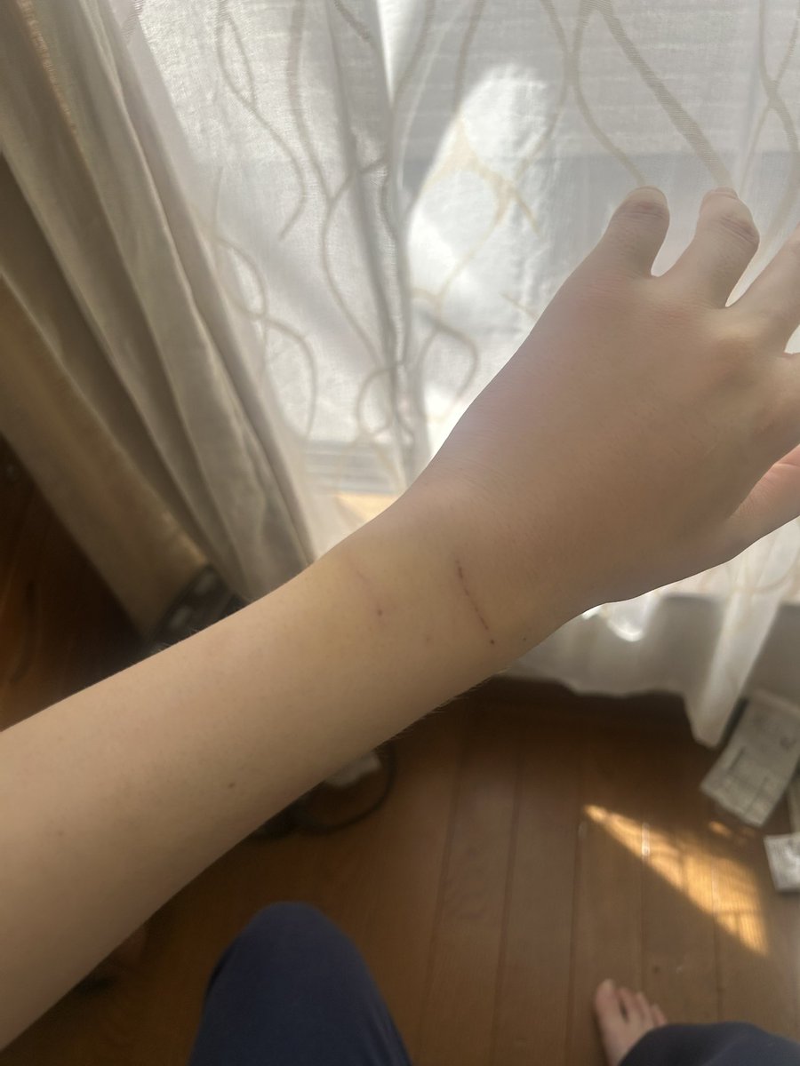 kanajump0922's tweet photo. 自宅のイッヌに噛まれた所が5日経っても治らないし腫れ引かないから病院きたけど
なんや危うく破傷風？手術で膿を取る？ことになるやもだったw
とりま抗生剤でガンバる💪
みんな犬に噛まれたらすぐ病院行けよな✨️ https://t.co/F0ZNcOoGUg