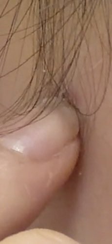 miapce478581's tweet photo. 数ミリだからわかりにくいけど私もここでやってこめかみから数ミリ糸でてる、連絡してみよ https://t.co/uIdlFv0faW
