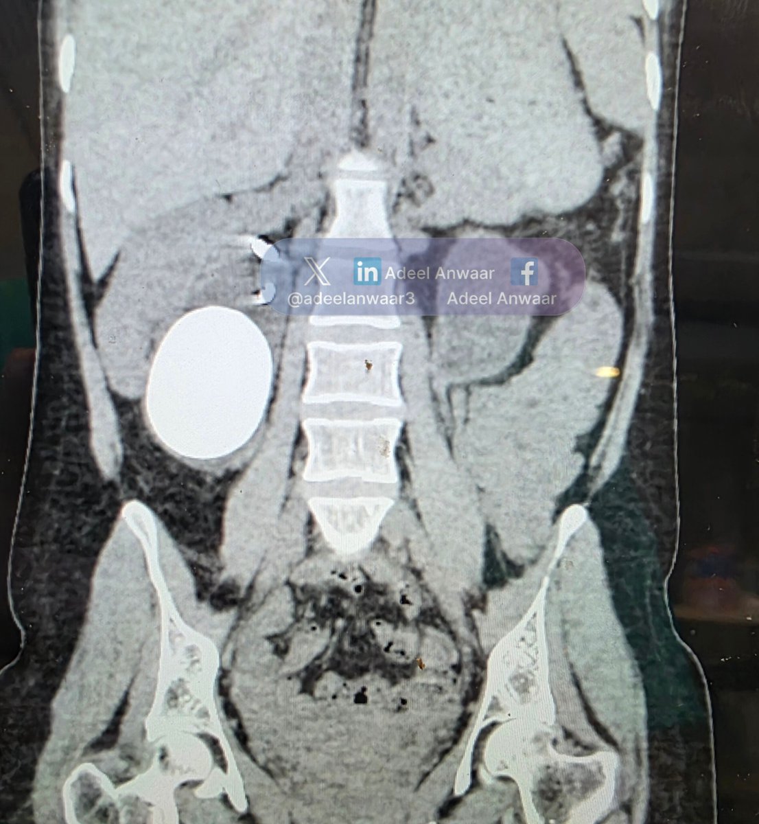 adeelanwaar3's tweet photo. Have you ever seen a renal stone this large with preserved renal function? 🪨😳
How would you proceed in a case like this?
how much do you think this stone weighs ⚖️
#Urology #Urologist #KidneyStones #RenalStone #StaghornCalculus #PCNL #RIRS #ECIRS #Endourology #StoneDisease #UrologySurgery #KidneyHealth #EndoscopicSurgery #UrologyCommunity #SurgicalUrology