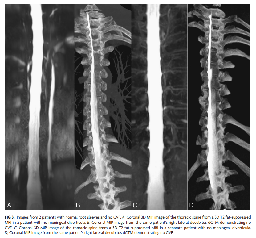 TheAJNR's tweet photo. "The Association of Spinal Meningeal Diverticula Number and Size with the Detection of CSF-Venous Fistulas: Evidence from a Contemporary Myelography Cohort"

https://t.co/0VVrjXqE2I https://t.co/ur21y5m9N7
