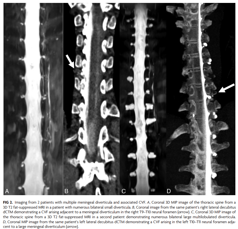 TheAJNR's tweet photo. "The Association of Spinal Meningeal Diverticula Number and Size with the Detection of CSF-Venous Fistulas: Evidence from a Contemporary Myelography Cohort"

https://t.co/0VVrjXqE2I https://t.co/ur21y5m9N7