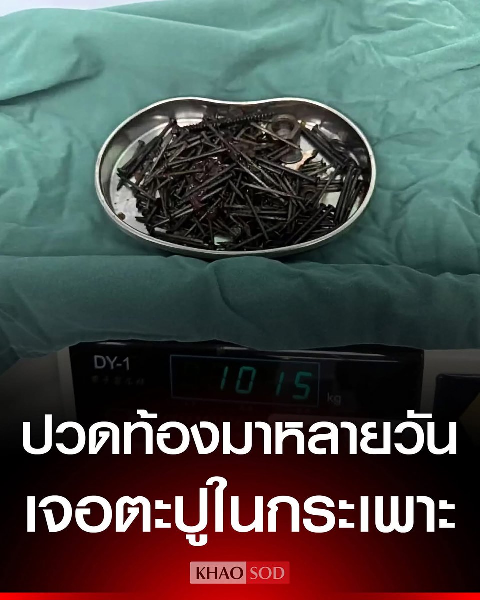 Wow_2569's tweet photo. แพทย์จีนอึ้ง😱

 เจอตะปู-เหรียญ-แม่เหล็กกว่า 180 ชิ้น 
หนักเกือบ 1 กก. ในกระเพาะคนไข้ https://t.co/uUU57HTUSo